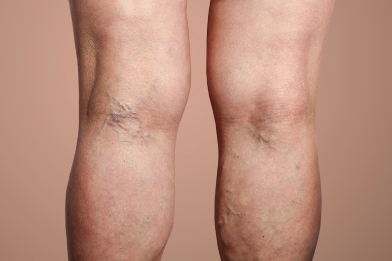 sind krampfadern gefaehrlich