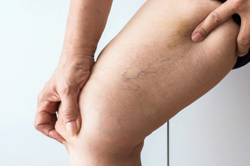 venenschwäche hausmittel